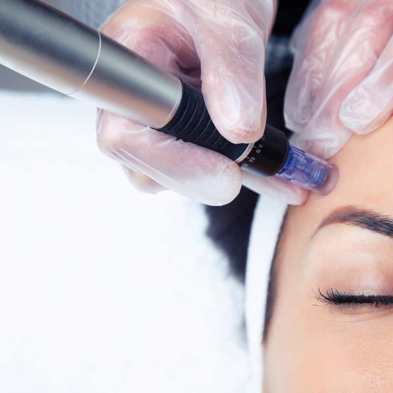 Morpheus8 treatment Kingshurst from Lipo Sculpt - Book in today!