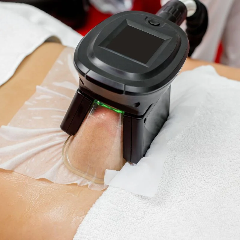 Fat Freezing treatment Kingshurst